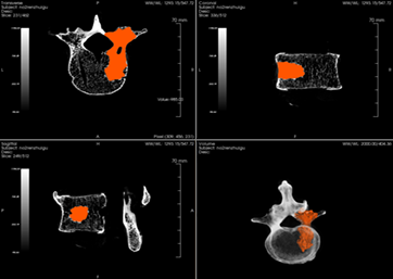 Segmentation and calculation of bone cement