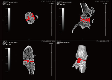 Volume calculation of knee joint cavity