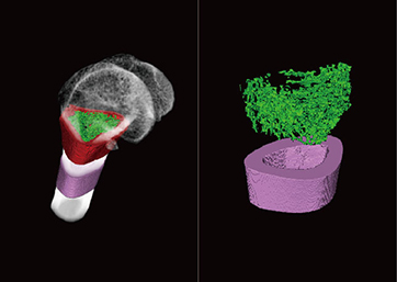 3D perspective display; segmentation and extraction of bone cerebellum and cortical bone