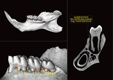 Measurement of the distance from alveolar process to the margin of gum